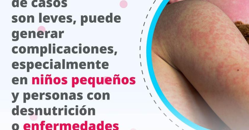 VACÚNATE CONTRA EL SARAMPIÓN Y PROTEGE TU SALUD