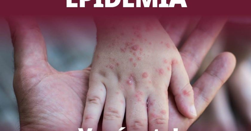 SARAMPIÓN: VACUNARSE ES PROTEGER LA VIDA